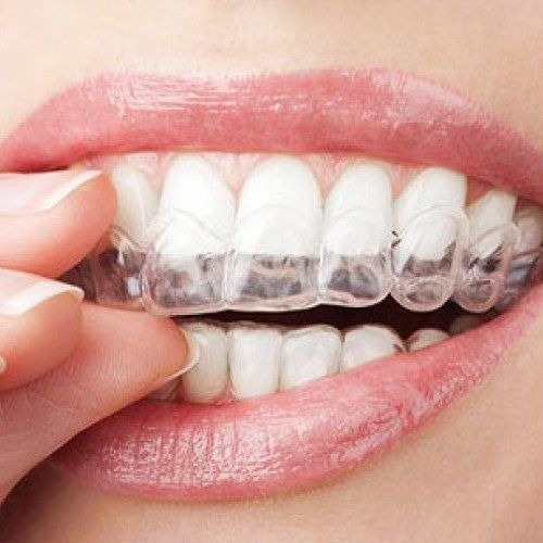 Choosing The Right Clear Aligner System For Invisible Braces